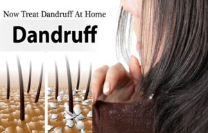 All you need to know about Dandruff Causes and Treatment
